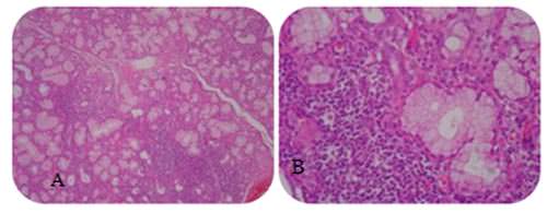 Fig 2 A. Sialoadenitis linfocítica de 4 focos por campo. X20. H-E. B . Sialoadenitis linfocítica del parénquima glandular a mayor aumento ,en biopsia labial inferior. X40. H-E