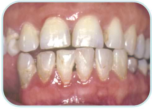 Fig 3 Paciente con SS y enfermedad periodontal