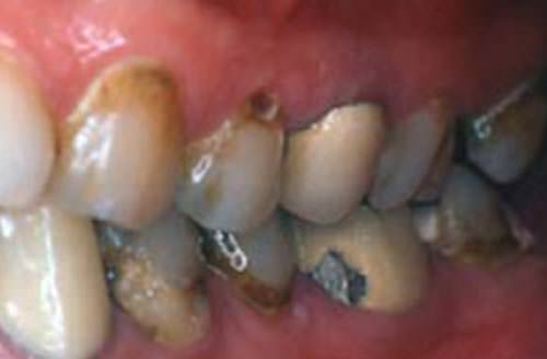 Figura 4 Caries cervicales en paciente con diagnóstico de SS