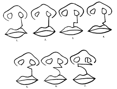 Diseños de diferentes técnicas para reparar el labio hendido Figura Nº7: 1. Mirault (1884),2. Rose (1891), 3. Hagedorn - Le Mesurier (1892 - 1949),4. Tennyson (1952), 5. Win, 6. Millard (1957), 7. Asensio (1971).