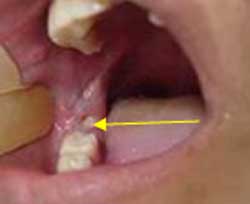 Leucoplasia
