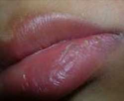 Queilitis Actínica