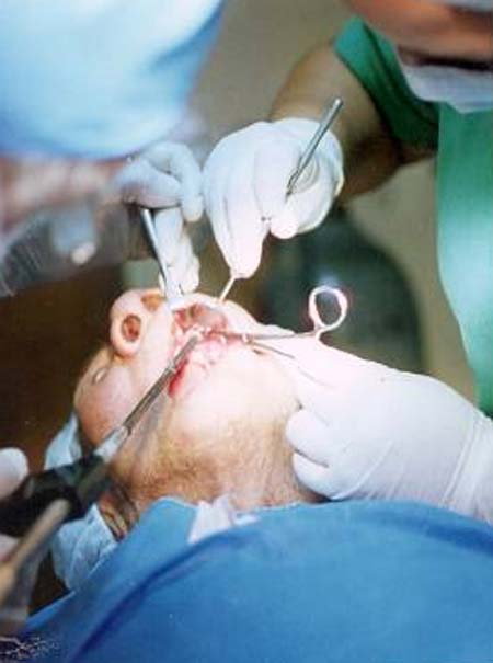Abordaje de nervio subobitario del trigémino en dermatoma trigeminal izquierdo con anestesia local. Paciente octogenario resistente a medicación antineurálgica