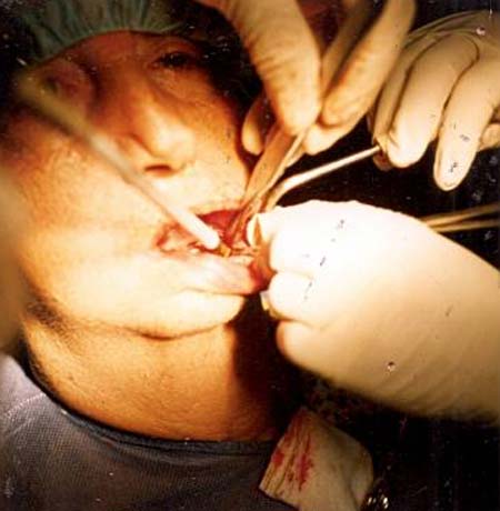 Crioterapia con probeta cerrada. V3