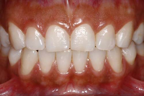 Figura 1B Vista aproximada del desgaste en los dientes antero-superiores con compromiso de los bordes incisales y de las troneras incisales.