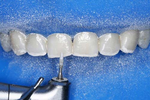 Figura 3 Biselado cóncavo con fresa diamantada 1111, con el objetivo de mejorar la estética y evitar el sobre contorno.