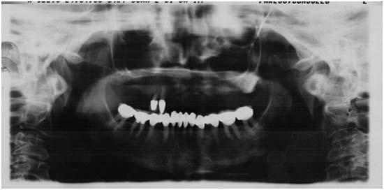 Fig 2 Radiografía panorámica