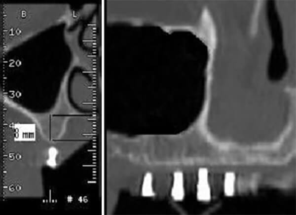 Fig 3 Izquierda: Preoperatorio corte frontal del 26. Derecha: Corte sagital región seno maxilar izquierdo Con referencias en gutapercha que indican futura posición del implante