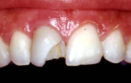 Figura 1 Diente 11 con faceta vestibular fracturada