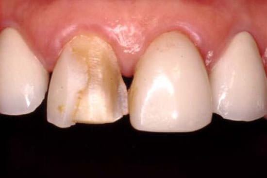 Figura 1 Diente 11 con faceta vestibular fracturada