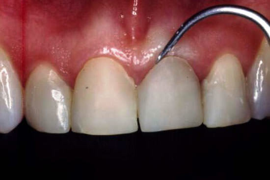 Figura 1 Dientes 11 y 21 con facetas presentando batiente cervical