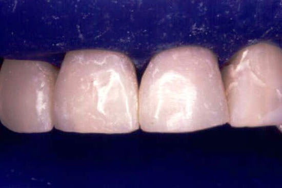 Figura 3 Facetas en los dientes 11 y 21 concluídas