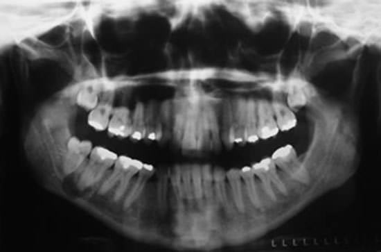 Figura 1 Examen radiográfico inicial. Observar la dimensión de la lesión, en la región posterior de la mandibula del lado derecho.
