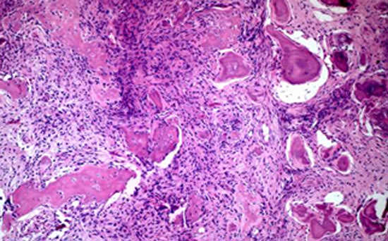 Figura 2 Aspectos histológico del espécimen. Verificar las gotas de cemento dispersas en un estroma de tejido celular fibroso (50x, H-E)