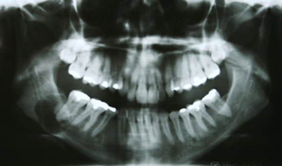 Figura 3 Examen radiográfico 48 meses después del diagnóstico inicial. Observar dimensión de la lesión aumentada el doble, en la región posterior de la masndíbula.