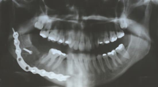 Figura 4 Examen radiográfico con 15 días de post-operatotio, muestra la placa de reconstrucción respetando el contorno óseo mandibular.