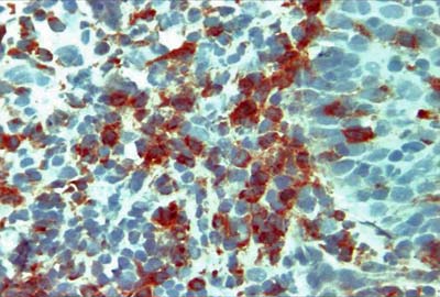 Fig. Nº 1 Linfocitos T citotóxicos CD8+ en tejido de Estomatitis Aftosa Recurrente 40X