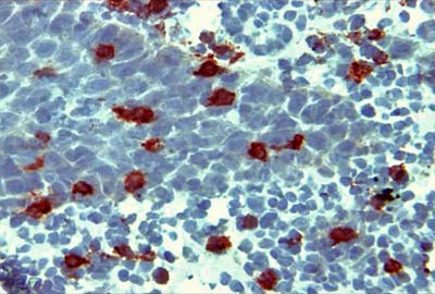 Fig. Nº 2 Linfocitos T ayudadores-inductores CD4+ en tejido de Estomatitis Aftosa Recurrente 40X