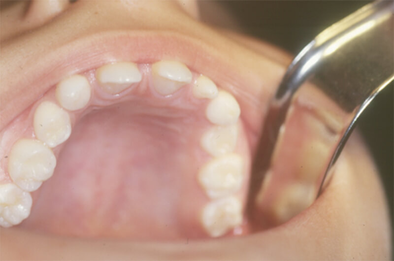 Figura 2 Aspecto intrabucal