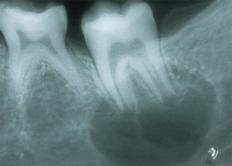 Figura 5 Rx. Periapical zona del 36