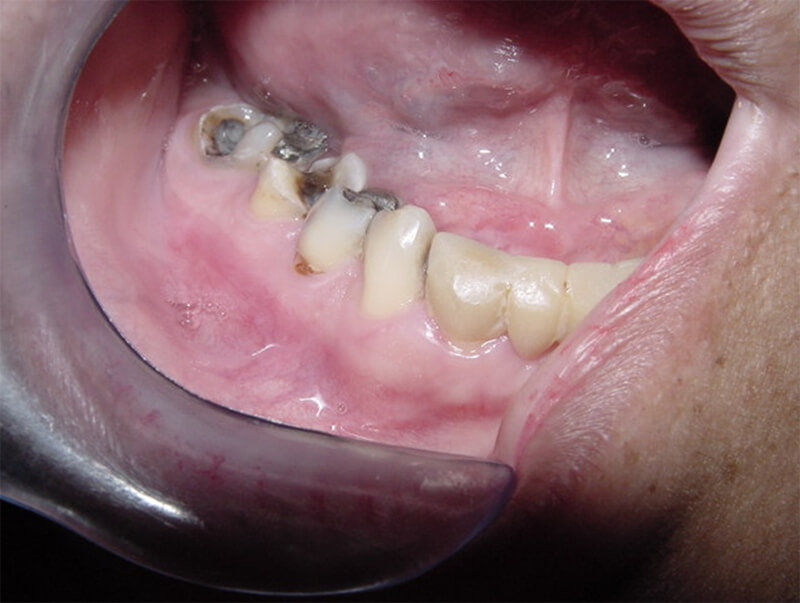 Figura 1: Examen clínico intrabucal