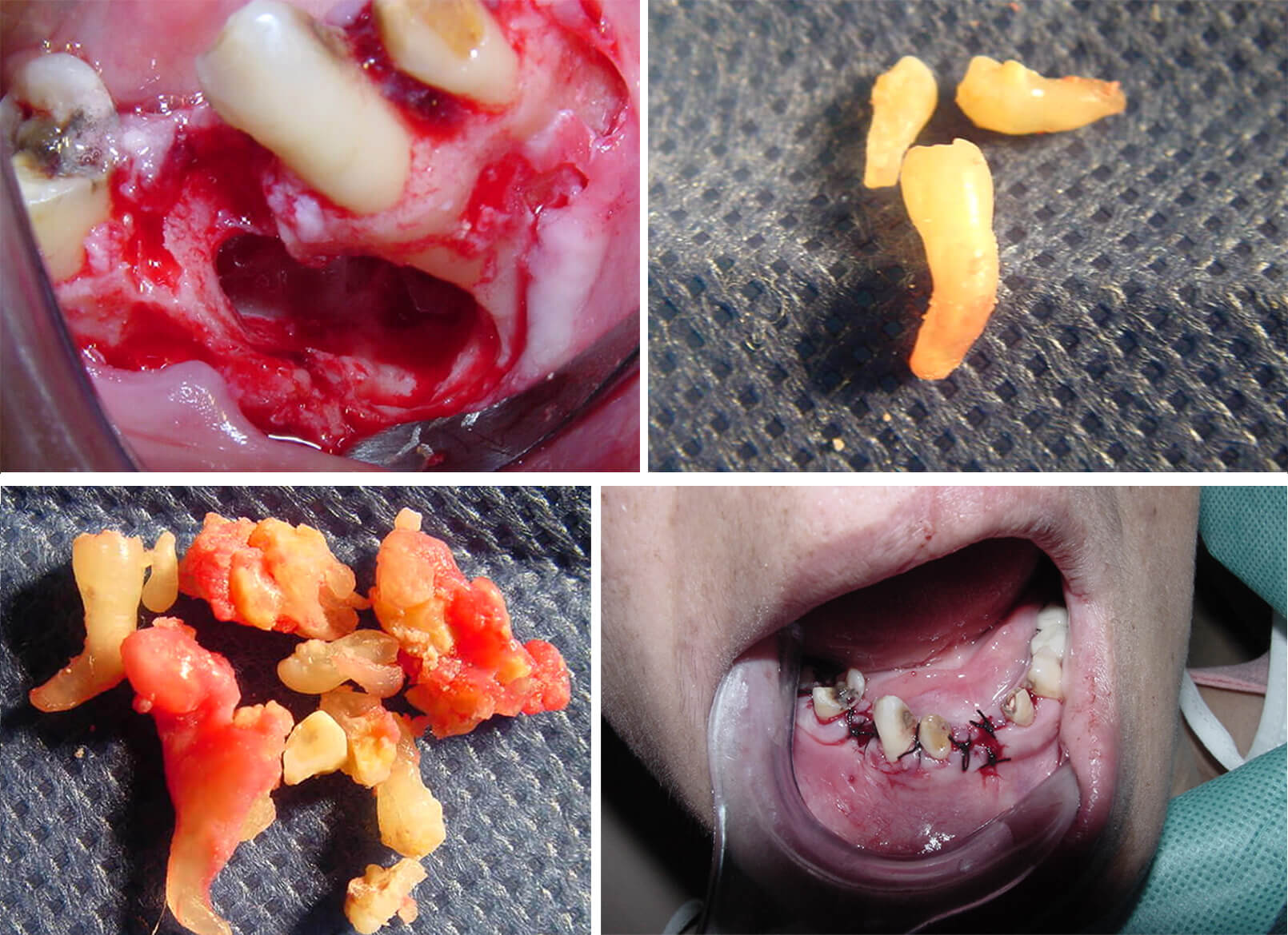 Figura 3-a - Figura 3-b - Figura 3-c - Figura 3-b Figura 3: Abordaje quirúrgico de la lesión. Nótese la gran cantidad de dentículos presentes (3, b-c)