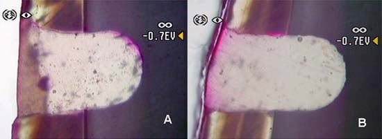 Figura 4: Presencia de microfiltración marginal: (A) Grupo punta diamantada CVD ultrasónica (B) Grupo punta diamantada convencional.