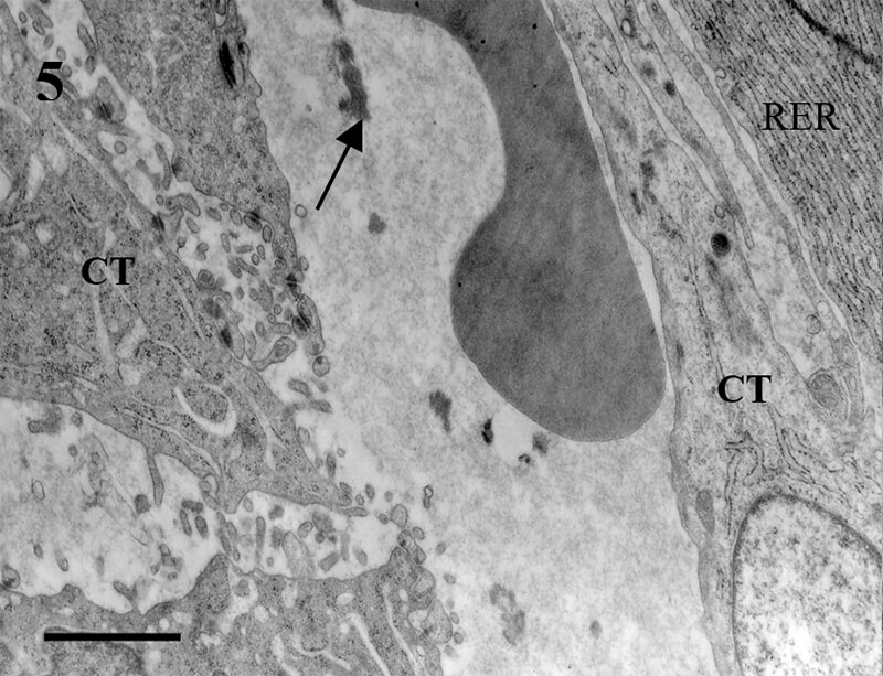 Fig. 5. CA . CT: células tumorales, adyacente al citoplasma de un plasmocito con abundante RER. E: eritrocitos. Flecha.: fibrina. Bar=0.5μm
