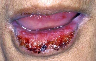 FIGURA 1 - Extensas áreas úlceradas en semi mucosa labial inferior, recubiertas con una costra hemorrágica.