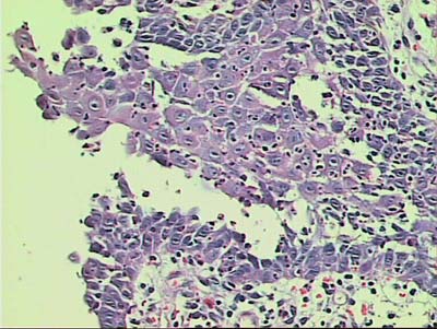 FIGURA 5 - Ampolla intraepitelial con preservación de la camada basal del epitelio adherido al conjuntivo subyacente. H.E.100X.