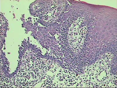 FIGURA 6 - Células acantolíticas adentro de la ampolla intraepitelial e infiltrado inflamatorio en el téjido conjuntivo subepitelial. H.E. 400X.