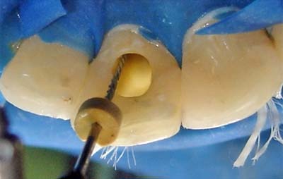 Fig. 12 - Cemento resinoso aplicado con lima endodóntica