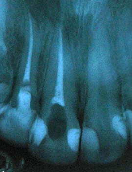 Fig. 2 - Evaluó la calidad de la terapia endodóntica ejecutada
