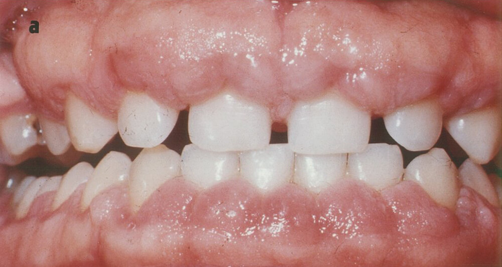Fig. 1-a Obsérvese el agrandamiento gingival de apariencia fibrosa.