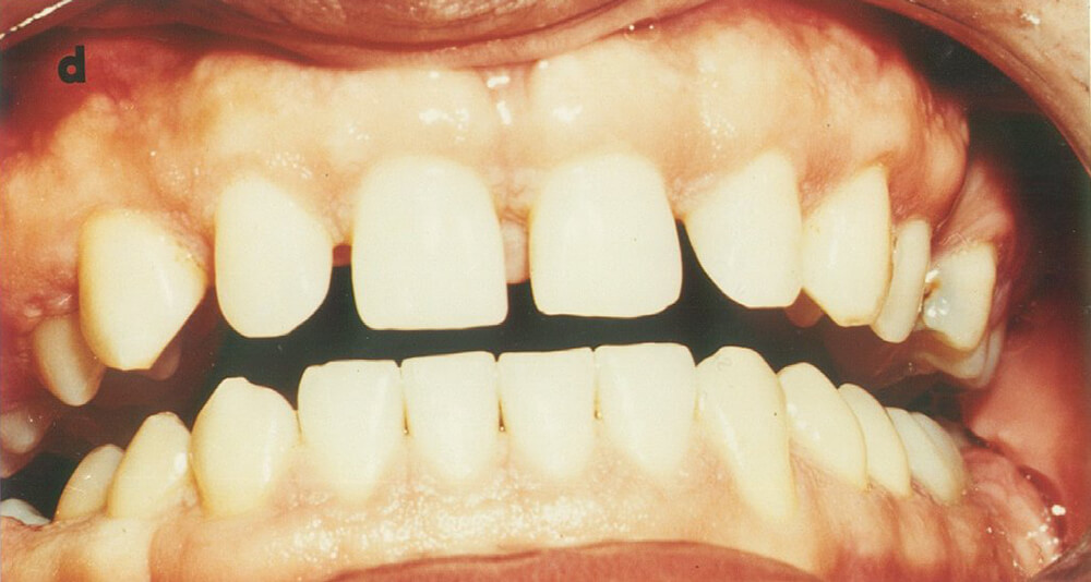 1-d.- Posoperatorio mediato donde se aprecia la obtención de una morfología gingival vestibular adecuada.
