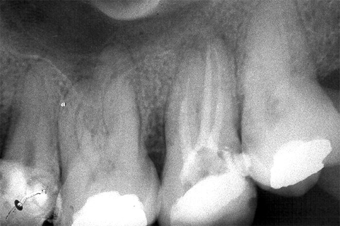 Figura 2 Radiografía periapical