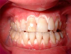 Figura 1: Injuria Química por tratamiento de blanqueamiento dental con peroxido de hidrogeno al 15%, en encía de los dientes anteriores maxilares y mandibulares en paciente adulta que asiste a consulta