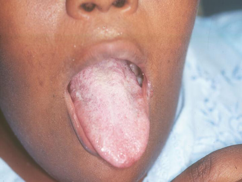 Figura 4: Placas blancas en cara dorsal de la lengua