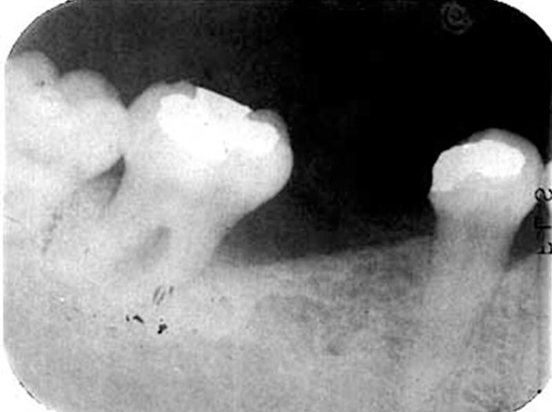 Figura 6: Rx periapical zona 7 8 inferior