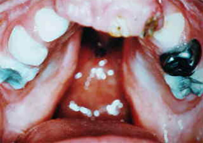 Figura 2. Hendidura labio-palatina bilateral completa, microdoncia, oligodoncia, caries rampante, hipoplasia del esmalte.