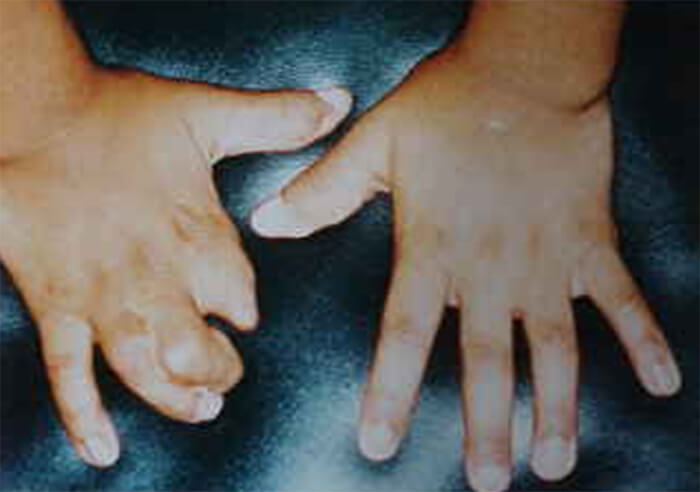 Figura 3: Manos con Sindactilias y ectrodactilia.