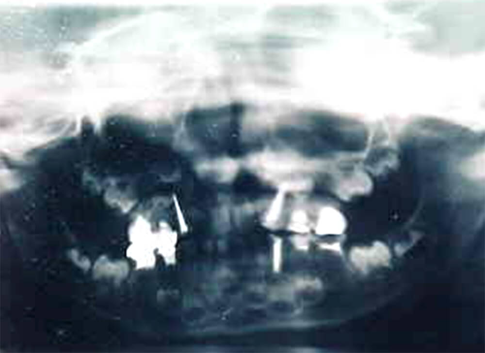 Figura 5: Radiografía Panorámica postoperatoria que da un aspecto global del tratamiento dental realizado durante el acto anestésico.