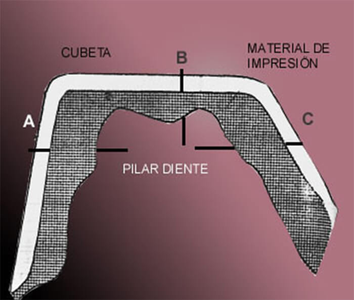 Dibujo 1. Espesor del material de impresión Fuente: Valderhaug, J. y Floystrand, F.(1984). J.P.D. 52(4):2