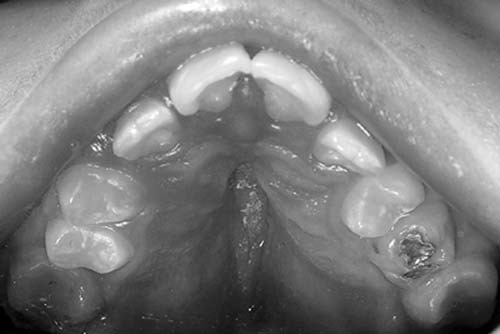 Figura 4 - Examen clínico intrabucal: paladar estrecho.