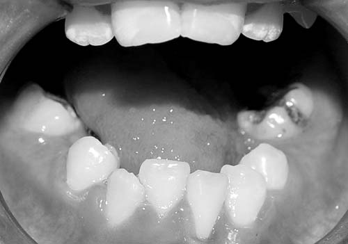Figura 6 - Examen clínico intrabucal: apiñamiento de varios dientes y un gran número de lesiones de caries.