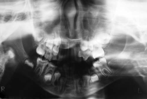 Figura 7 - Radiografía panorámica: ausencia de anomalías dentales.