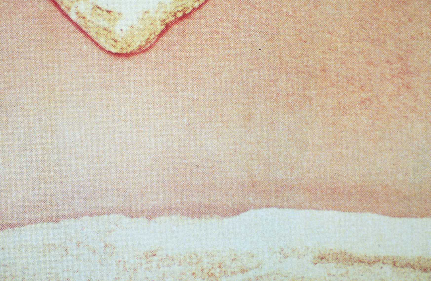 Fig. 2- Impacto de un Rayo Laser de Er: YAG en un diente. Note la formación de dentina adyacente al impacto Laser. Fotomicrografía X 100.Tinción con Hematoxilina y Eosina. (Tomado de Zakariasen K. L.)