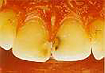 Fig. 10.- Tratamiento de la caries en los centrales superiores con un Rayo Laser de Er:YAG. Aspecto clínico. (Tomado de Miserendino L., Pick R.)