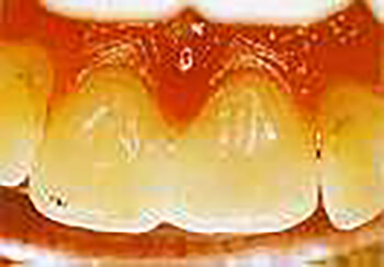 Fig. 12.- Dientes estéticamente reconstruidos con resinas fotocuradas. (Tomado de Miserendino L., Pick R.)