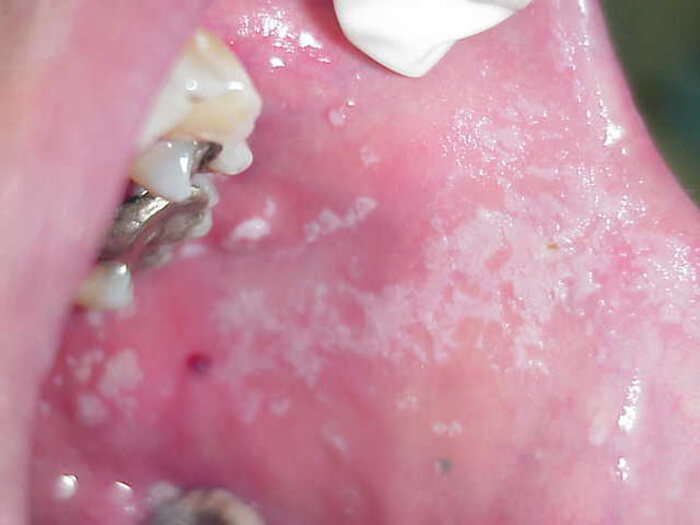 Foto 2: Candidiasis Pseudomembranosa e hiperpigmentación melaninica